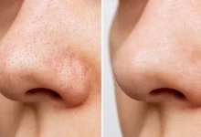 Shrink Pores